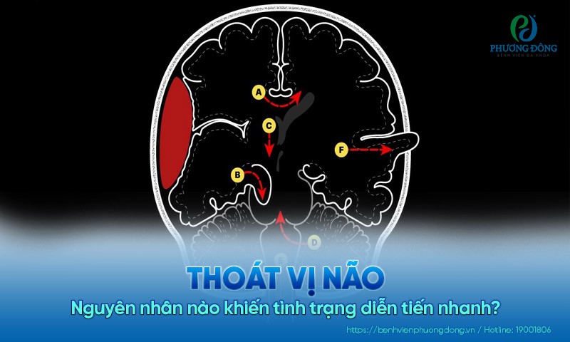 Thoát vị não: Nguyên nhân nào khiến tình trạng diễn tiến nhanh?