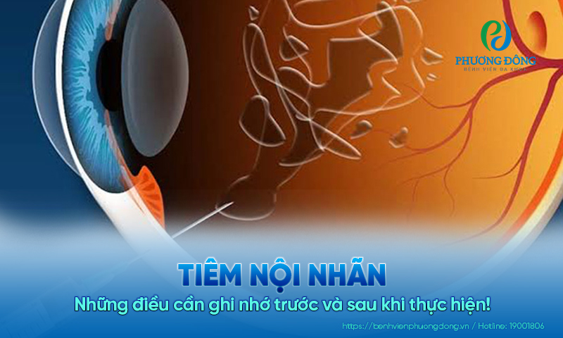 Tiêm nội nhãn: Những điều cần ghi nhớ trước và sau khi thực hiện!