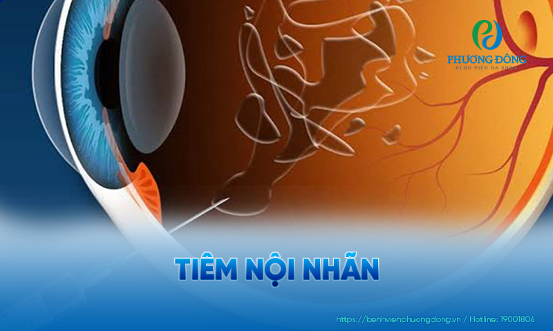 Thuốc tiêm nội nhãn có thể là thuốc kháng sinh, thuốc chống viêm hoặc Anti-VEGF