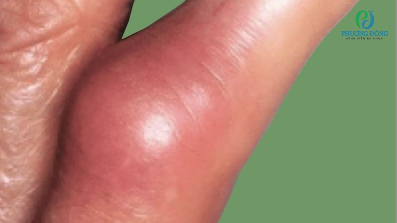 Nhiễm khuẩn khớp do vết thương ngoài da, đường máu, vết cắt hở khiến khớp ngón tay tăng tiết dịch