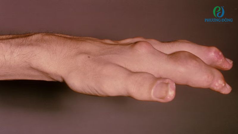 Một số cách phòng ngừa tràn dịch khớp ngón tay tại nhà