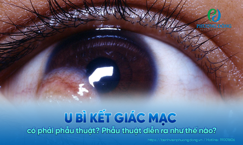 U bì kết giác mạc có phải phẫu thuật? Phẫu thuật diễn ra như thế nào?