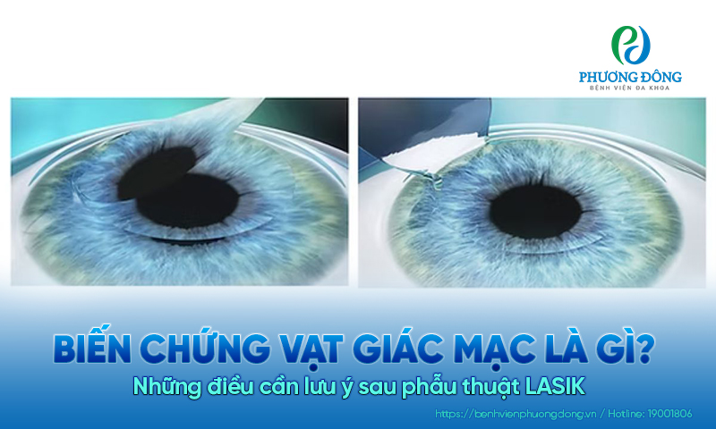Biến chứng vạt giác mạc là gì? Những điều cần lưu ý sau phẫu thuật LASIK 
