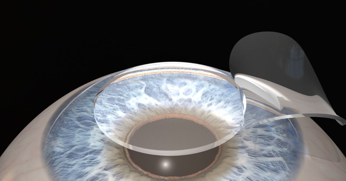 Vạt được tạo thành sau đó được lật sang 1 bên