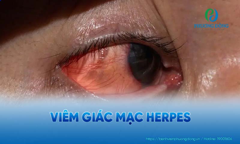 Phản ứng viêm do virus Herpes gây ra khá thường gặp
