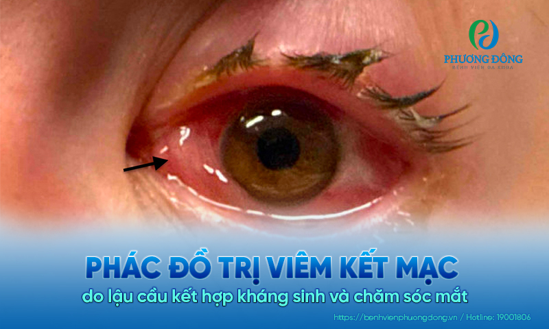 Phác đồ trị viêm kết mạc do lậu cầu kết hợp kháng sinh và chăm sóc mắt  