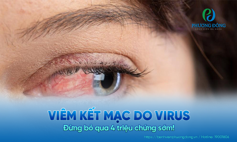 Viêm kết mạc do virus: Đừng bỏ qua 4 triệu chứng sớm! 