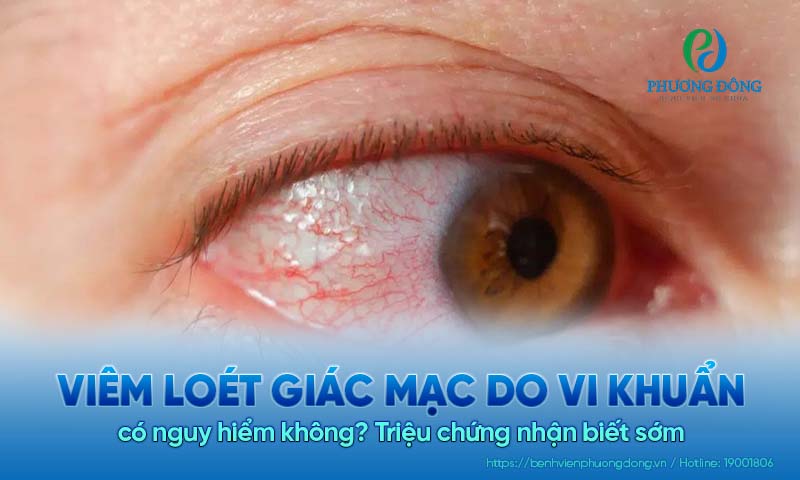 Viêm loét giác mạc do vi khuẩn có nguy hiểm không? Triệu chứng nhận biết sớm 