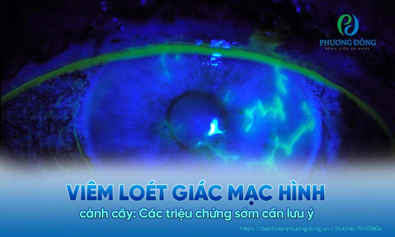 Viêm loét giác mạc hình cành cây: Các triệu chứng sớm cần lưu ý 