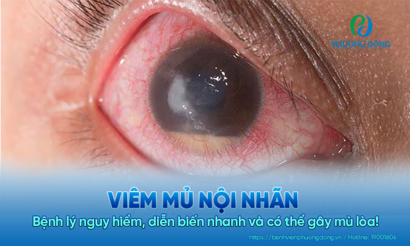 Viêm mủ nội nhãn: Bệnh lý nguy hiểm, diễn biến nhanh và có thể gây mù lòa!
