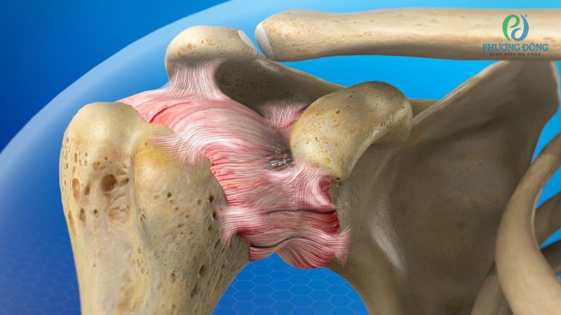 Giai đoạn đông cứng khiến khớp vai co cứng nghiêm trọng