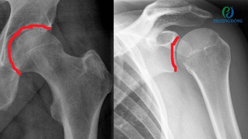 Phương pháp chẩn đoán đông cứng khớp vai