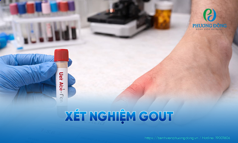 Xét nghiệm gout dành cho ai? Khi nào nên thực hiện? Lưu ý dành cho bệnh nhân