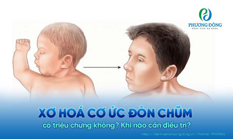 Xơ hoá cơ ức đòn chũm có triệu chứng không? Khi nào cần điều trị?