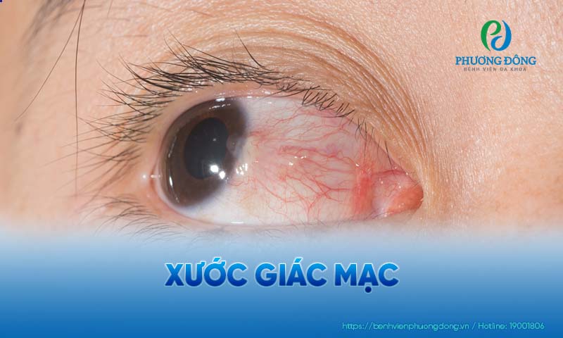 Giác mạc bị xước có thể khiến thị lực của người bệnh suy giảm