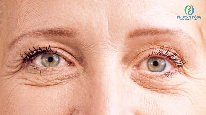Giải đáp cùng bác sĩ: Bọng mắt chảy xệ phải làm sao?