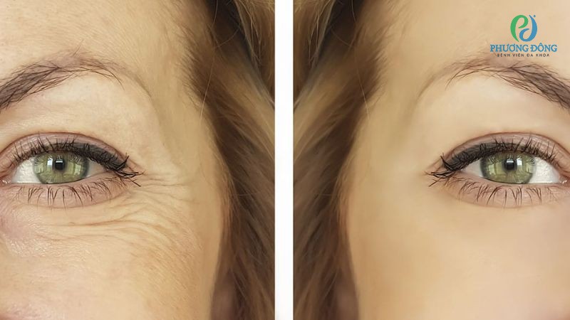 Một số biện pháp cải thiện tình trạng chảy xệ bọng mắt