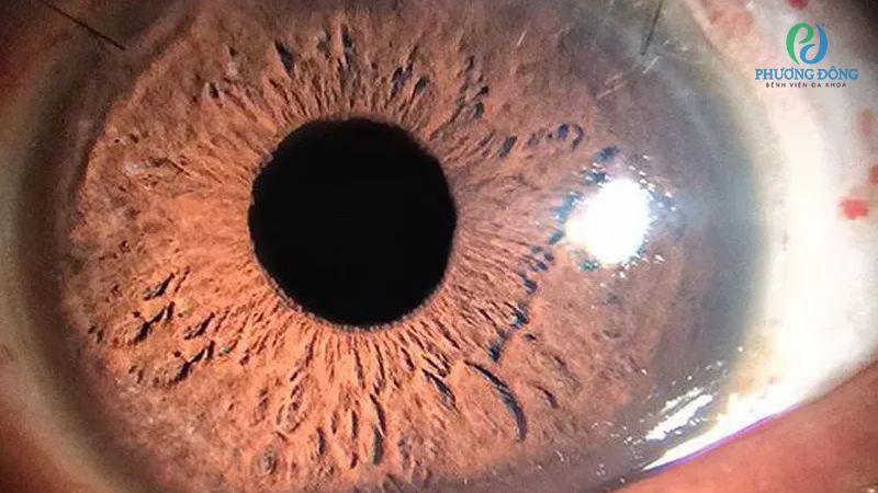 Hỏi đáp bác sĩ chuyên khoa Mắt: Khâu giác mạc bao lâu thì khỏi?