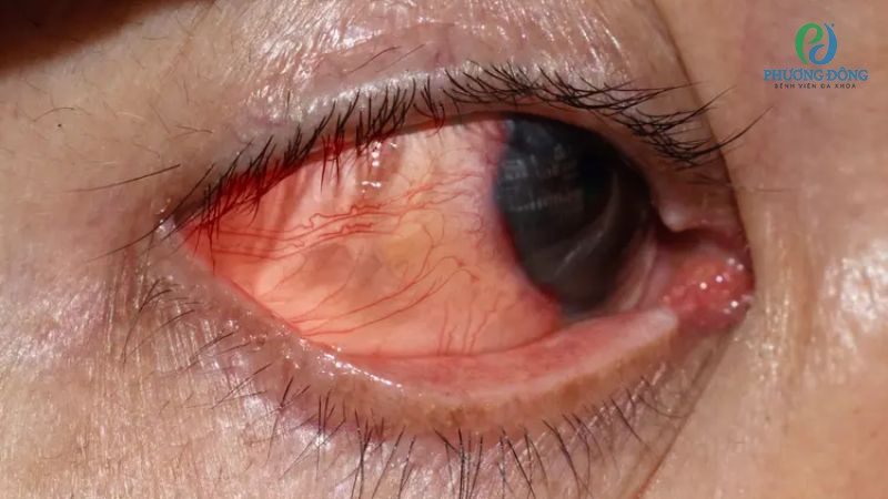 Hỏi đáp chuyên gia Nhãn khoa: Rách giác mạc có nguy hiểm không?