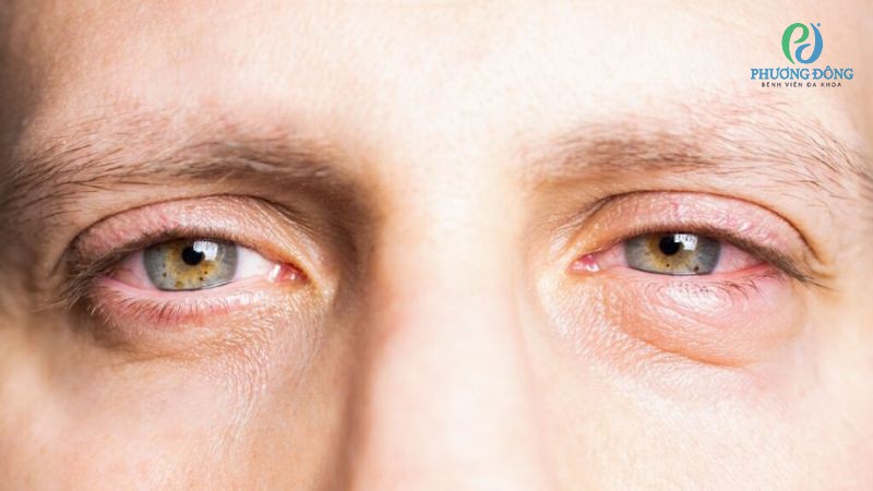Bọng mắt sưng do tích tụ dịch quá mức, lão hóa hoặc liên quan đến phản ứng kích ứng quá mẫn