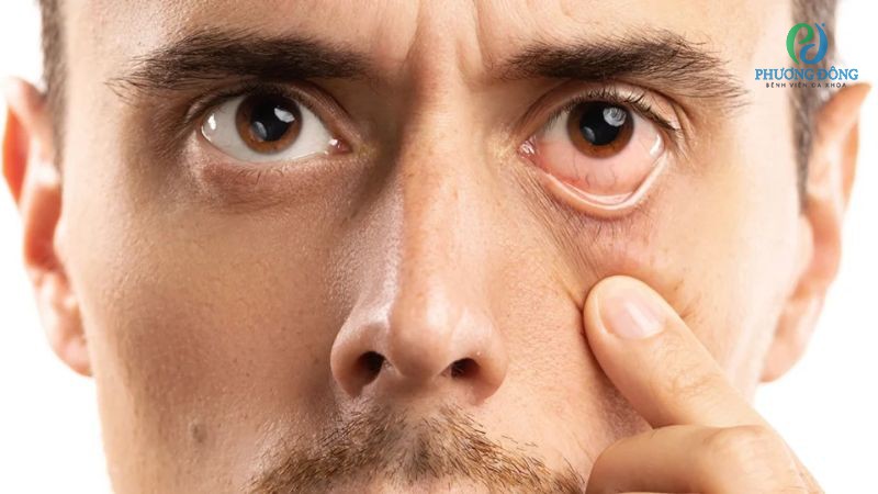 Hỏi đáp bác sĩ chuyên khoa Mắt: Tại sao bọng mắt sưng?