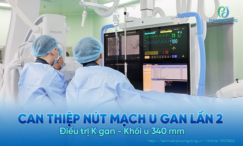 Hành trình can thiệp nút mạch lần 2: Điều trị K gan - Khối u 340 mm