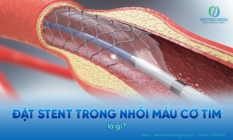 Đặt stent trong nhồi máu cơ tim: Chỉ định, chống chỉ định và quy trình đặt