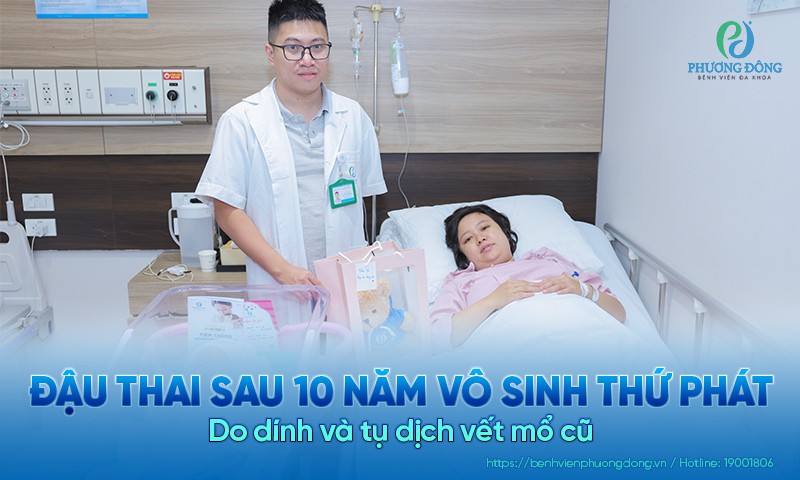 Đậu thai sau 10 năm vô sinh thứ phát do dính và tụ dịch vết mổ cũ