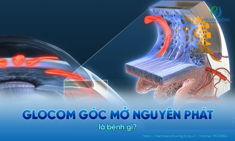 Glocom góc mở nguyên phát: Triệu chứng, nguyên nhân và điều trị