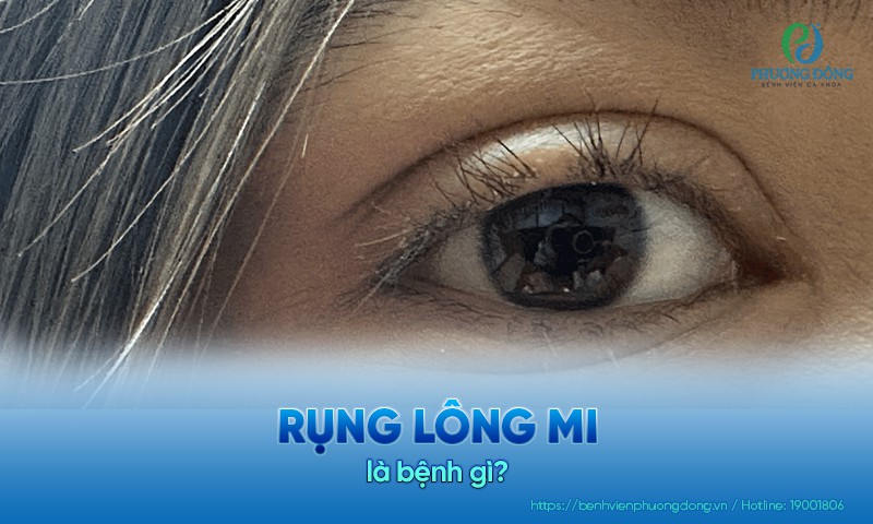 Rụng lông mi: Nguyên nhân và biện pháp cải thiện