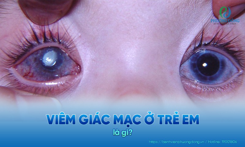 Viêm giác mạc ở trẻ em: Nguyên nhân, triệu chứng và điều trị