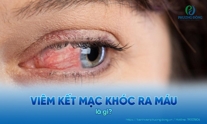 Viêm kết mạc khóc ra máu: Nguyên nhân và hướng điều trị