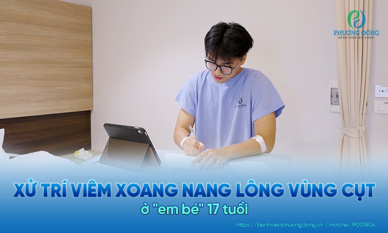 Tưởng là nốt mụn nhỏ, nam sinh bất ngờ nhập viện vì viêm xoang nang lông vùng cùng cụt