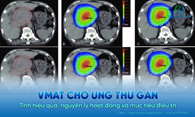 VMAT cho ung thư gan có hiệu quả không? Nguyên lý và mục tiêu