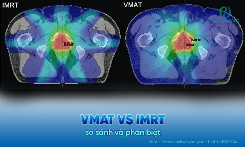 VMAT vs IMRT: Kỹ thuật xạ trị nào tối ưu hơn cho bệnh nhân ung thư?