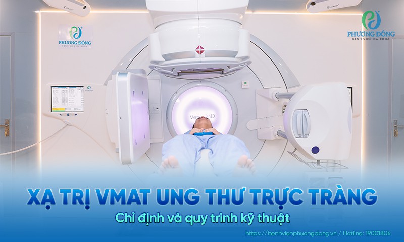 Xạ trị VMAT ung thư trực tràng: Chỉ định, ưu điểm và quy trình kỹ thuật