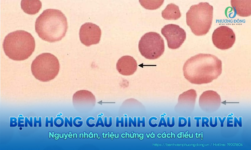 Bệnh hồng cầu hình cầu di truyền: Nguyên nhân, triệu chứng và cách điều trị