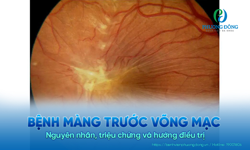 Bệnh màng trước võng mạc: Nguyên nhân, triệu chứng và hướng điều trị 