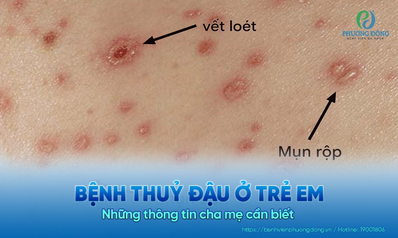 Bệnh thuỷ đậu ở trẻ em: Những thông tin bạn cần biết 