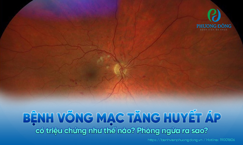 Bệnh võng mạc tăng huyết áp có triệu chứng như thế nào? Phòng ngừa ra sao?