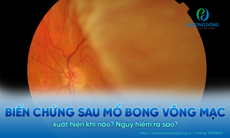 Biến chứng sau mổ bong võng mạc xuất hiện khi nào? Nguy hiểm ra sao? 