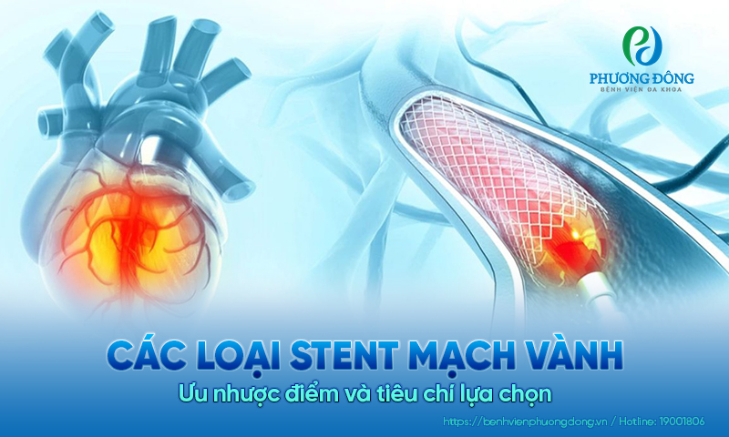Các loại stent mạch vành: Ưu nhược điểm và tiêu chí lựa chọn 