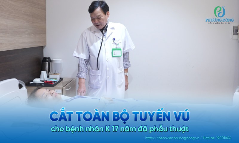 Cắt toàn bộ tuyến vú cho bệnh nhân K 17 năm đã phẫu thuật 