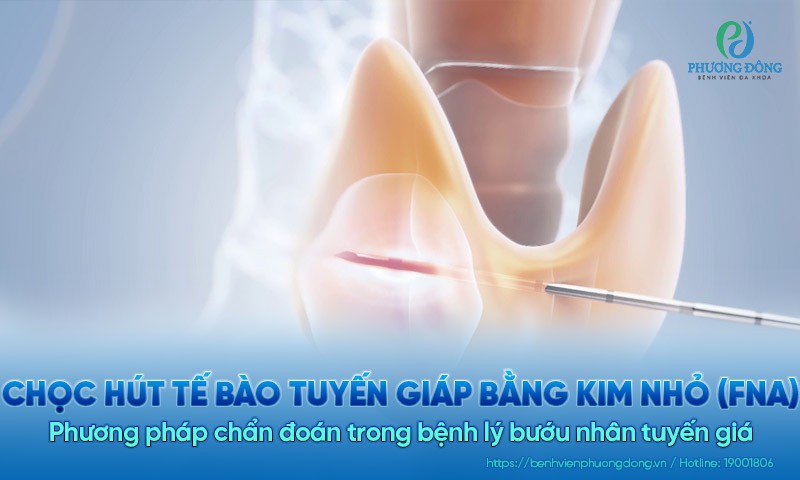 Chọc hút tế bào tuyến giáp bằng kim nhỏ (FNA): phương pháp chẩn đoán quan trọng trong bệnh lý bướu nhân tuyến giáp