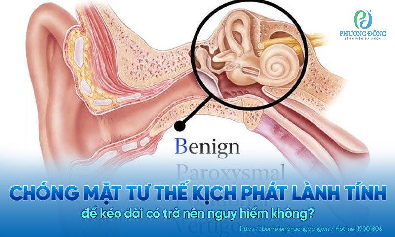 Chóng mặt tư thế kịch phát lành tính để kéo dài có trở nên nguy hiểm không?