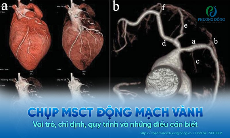 Chụp MSCT động mạch vành: Vai trò, chỉ định, quy trình và những điều cần biết