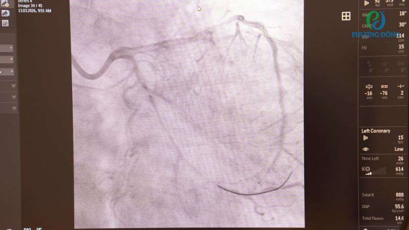 Stent phủ thuốc thường được sử dụng nhờ khả năng giảm nguy cơ tái hẹp sau thủ thuật