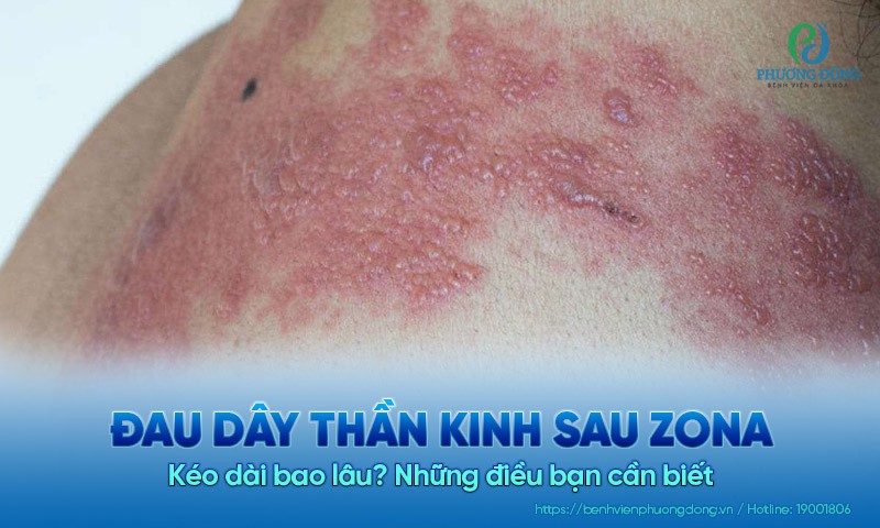Đau dây thần kinh sau Zona kéo dài bao lâu? Những điều bạn cần biết