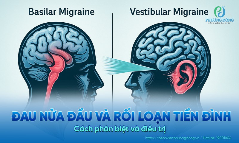 Đau nửa đầu và rối loạn tiền đình: Cách phân biệt và điều trị