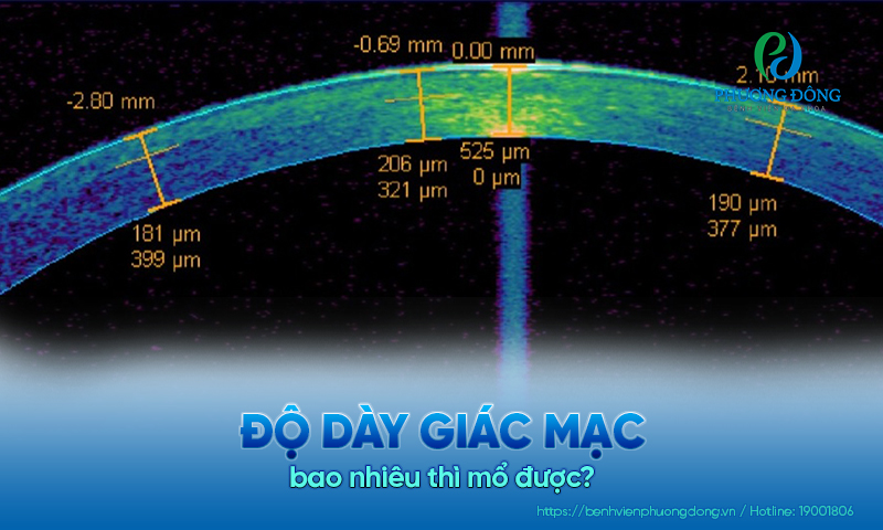 Bệnh nhân hỏi - Bác sĩ trả lời: Độ dày giác mạc bao nhiêu thì mổ được?